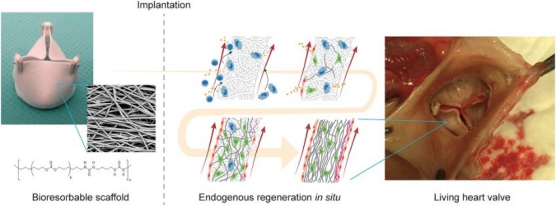 使用生物可吸收弹性植入物进行原位心脏瓣膜组织工程——从材料设计到绵羊 12 个月的随访